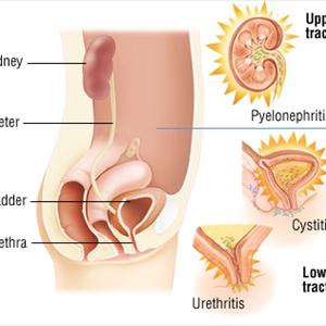 Home Remedies For Urinary Tract Infection - Urinary Tract Infection Antibiotics- Why Naturally Curing U.T.I. Works Better Than Antibiotics
