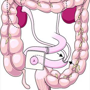 Urinary Tract Infection Natural Remedies - Urinary Infection Natural Remedy- How Vitamin C And Your Ph Level Cure U.T.I.S