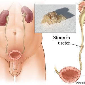 Smelly Urine - Bactrim- Urinary Tract Disease Cure