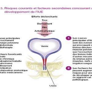 Burning When I Pee - Why Drinking Water Helps Prevent Urinary Tract Infections