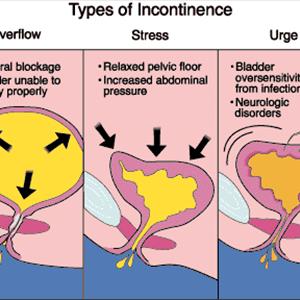 Constant Urinary Tract Infections - Cures Urinary - Tips To Cure Urinary Tract Infection